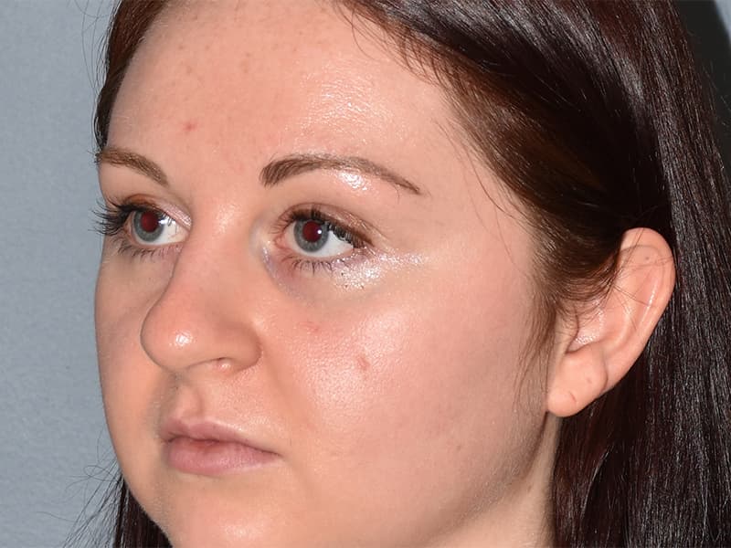 Rhinoplasty Before & After Image