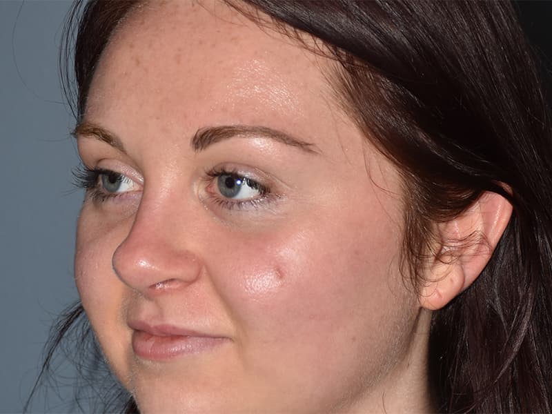 Rhinoplasty Before & After Image