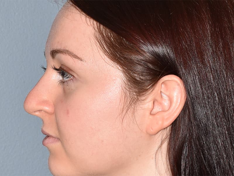 Rhinoplasty Before & After Image