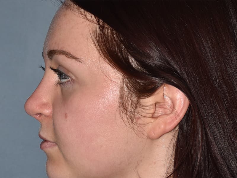 Rhinoplasty Before & After Image