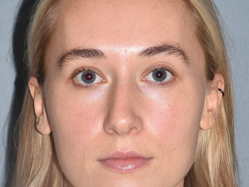 Rhinoplasty Before & After Image