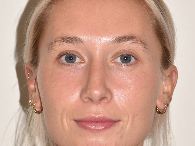 Rhinoplasty Before & After Image