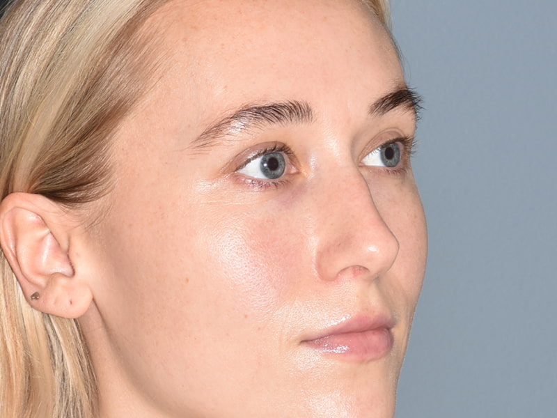 Rhinoplasty Before & After Image