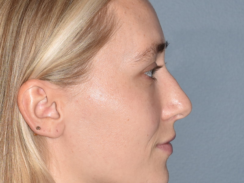 Rhinoplasty Before & After Image