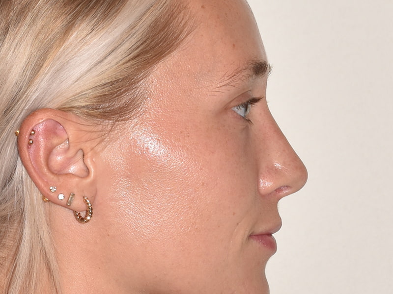 Rhinoplasty Before & After Image