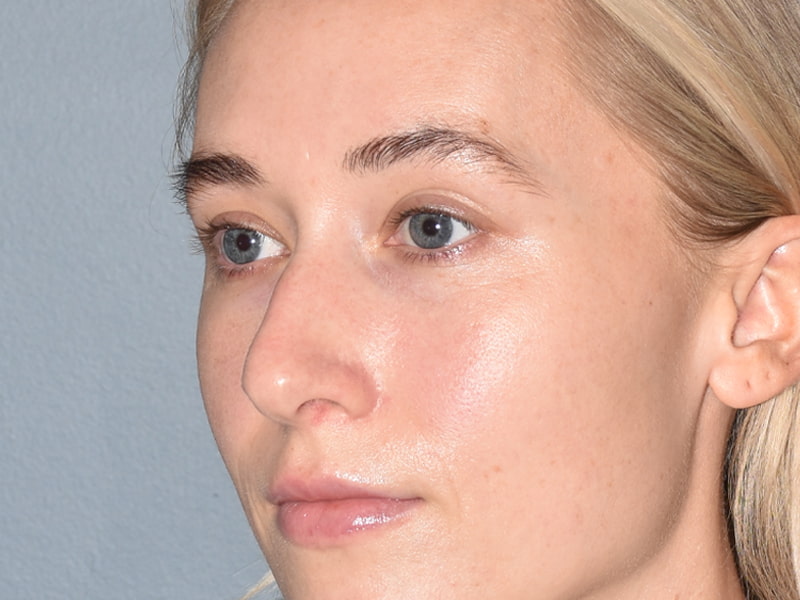 Rhinoplasty Before & After Image