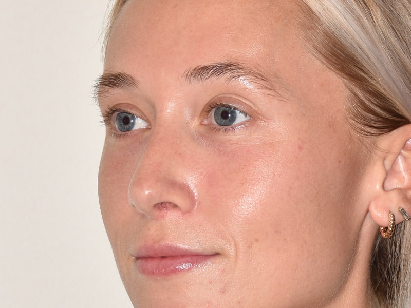 Rhinoplasty Before & After Image