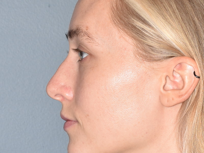 Rhinoplasty Before & After Image