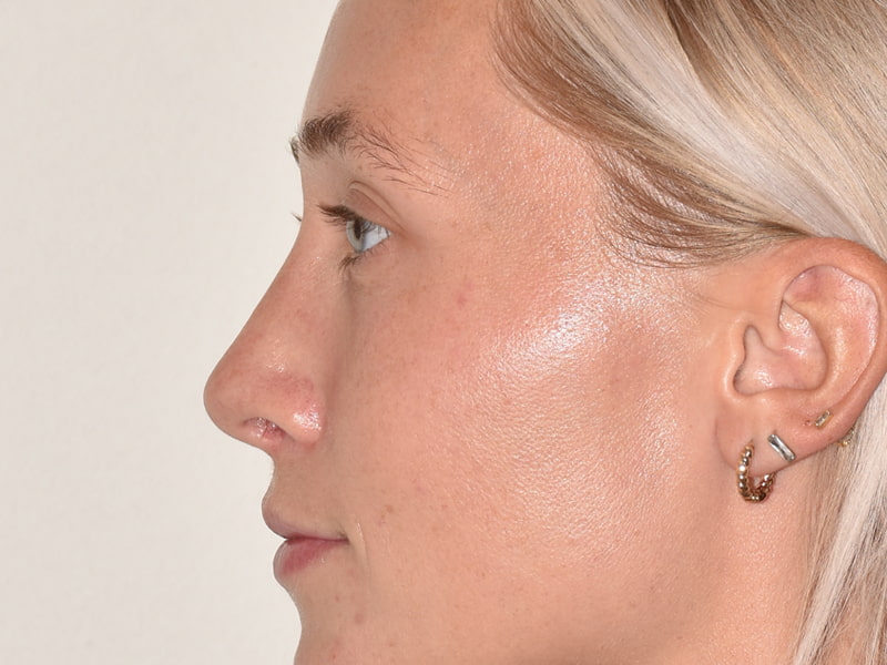 Rhinoplasty Before & After Image