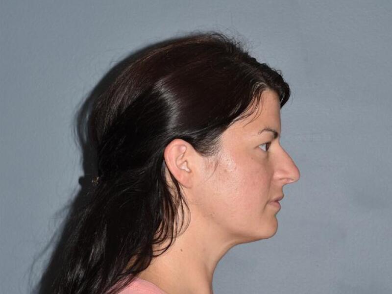 Rhinoplasty Before & After Image