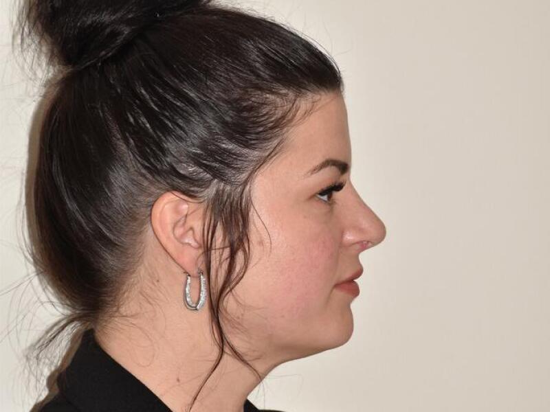 Rhinoplasty Before & After Image