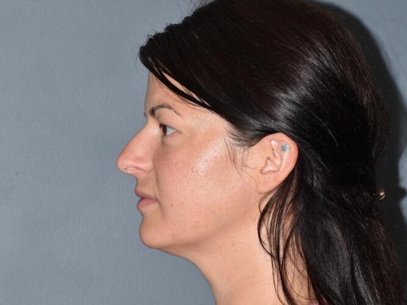 Rhinoplasty Before & After Image